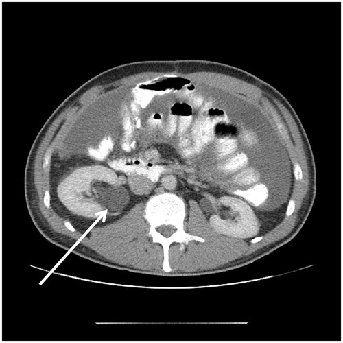 Figure 7. CT slice showing right pelvicaliectasis that may be caused by retroperitoneal cancer invasion of the right ureter.