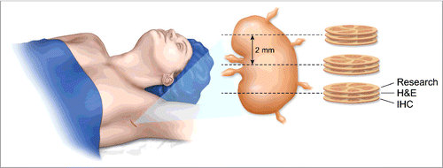 Figure 1. Artist depiction of technique for obtaining fresh nodal tissue from the sentinel lymph node for immunological analysis without compromising pathological analysis. The surrounding fat is removed from the sentinel lymph node and the node is sectioned into 2 mm gross sections. Each section is placed on a cryotome and a single shaving is removed from the top prior to freezing. This tissue is collected for immunological profiling. The remainder of the 2 mm section is then utilized for pathological analysis. On average there were four 2 mm sections processed resulting in four shavings from throughout the sentinel lymph node.