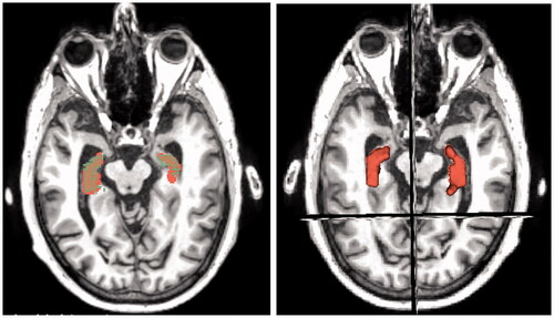 Figure 11. Data checking by comparison of 3D model (right) against the MRI scans (left).