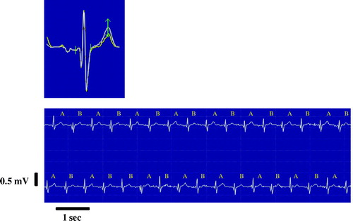 Figure 3.  A representative electrocardiogram tracing and superimposed complexes of the lead V5 illustrating exercise-induced T-wave alternans (TWA) of 71 microvolts in a patient who experienced sudden cardiac death caused by an acute myocardial infarction at 3 months following the recording. The superimposed waveforms (upper panel) and rhythm strip (lower panel) are provided. The bidirectional arrow refers to the point of maximum TWA.