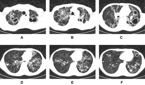 Figure 4 A 40-year-old male patient with XDR-TB. CT scans revealing whole-lung involvement with bronchiectasis, multiple cavities (some of them were thick-walled), proliferative lesions, calcifications, and disseminated lesions along the bronchi in both lungs (A–F). The predicted value of the model was 0.85848, and the result was predicted drug resistance, which was in agreement with DST.
