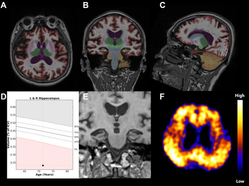 Figure 2 Representative 73-year-old woman with MCI. (A–C): Output from analysis with NeuroQuant shows segmentation of regional brain volumes. (D): Age-matched reference charts provided by NeuroQuant showing % of ICV and normative percentiles of hippocampal volume are 0.23 and 1, respectively. The prediction score calculated from age and hippocampal % of ICV was −9.44.(E): Coronal T1-weighted MR image shows hippocampal atrophy.(F): Positive amyloid imaging scans with “high” Pittsburgh compound B retention.