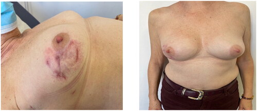 Figure 5. (POD90) 3 months after the surgery, complete recovery with minimal sequels due to the early diagnosis.