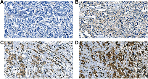 Figure 1 Representative images were shown for IHC staining intensity of ENO1 in breast cancer tissues. (A) No staining, (B) weak, (C) moderate, and (D) strong.