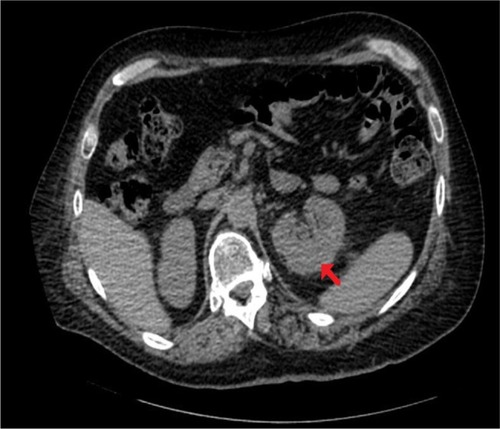 Figure 6 CT of kidneys.