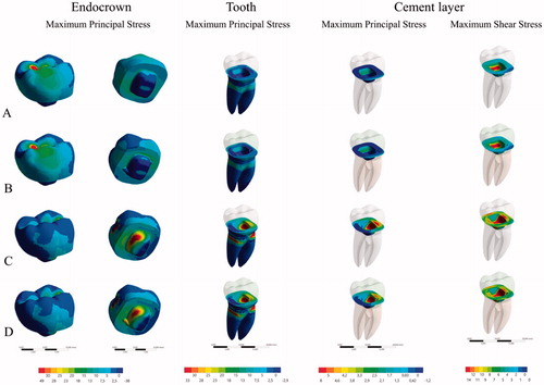 Figure 4. Stress maps according to each group: (A) in the conventional endocrown restorations with axial loading, (B) in the conventional endocrown restorations with lateral loading, (C) in the modified endocrown design with axial loading and (D) in the modified endocrown design with lateral loading.