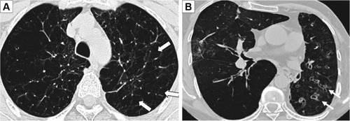 Figure 1 HRCT pictures showing emphysema (A) in the upper lobes (white arrows) and severe bronchiectasis (B) with bronchial wall thickening (white arrows).