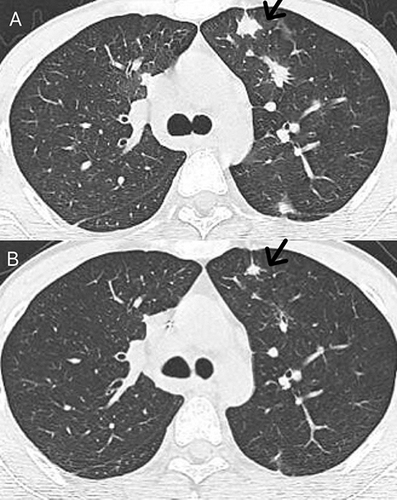 Figure 2 Computed Tomography (CT) of the lungs showed many small patches, nodules, and patchy high-density shadows, with blurred boundaries and uneven density (A). After six months of treatment, CT of the lung condition improved (B).