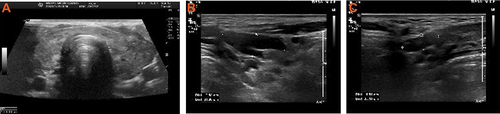 Figure 1 Color Doppler ultrasound images indicate the enlarged thyroid (A) and swollen lymph nodes ((B) left, (C) right).