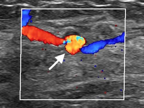 Figure 2 Color Doppler sonography illustrated that it was a localized dilated intramammary arteriole (arrow).