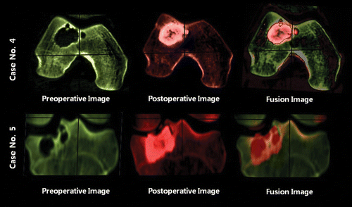 Figure 3. Representative pre- and post-operative CT scans and fusion images. All axial and coronal pre- and post-operative images were matched using a program of the Stryker Navigation System (iNtellect Navigation System version 1.0). Pre-operative images were converted to a green color, and post-operative images were red. The two images were then merged to compare the curetted margins of the benign bone tumors.