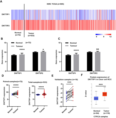 Figure 1 DNTTIP1 was highly expressed in ccRCC. (A) Heat map of DNTTIPs expression in TCGA-KIRC (n=605). (B) and (C) Relative DNTTIPs expression in TCGA-KIRC. (D) and (E) DNTTIP1 was highly expressed in TCGA-KIRC and clinical samples. (F) DNTTIP1 protein level was highly expressed in CPTAC data. Red indicates high expression; black indicates medium expression; green indicates low expression. CPTAC: Office of Cancer Clinical Proteomics Research. *P < 0.05, ***P < 0.001, and ****P < 0.0001.