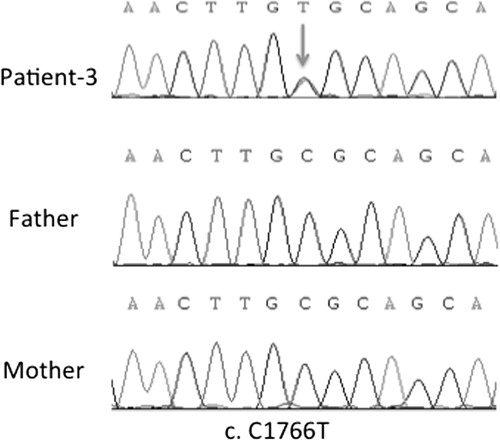 Figure 4. DNA sequencing profile of the c.1766C > T mutation in SLC4A1 gene in family-3.