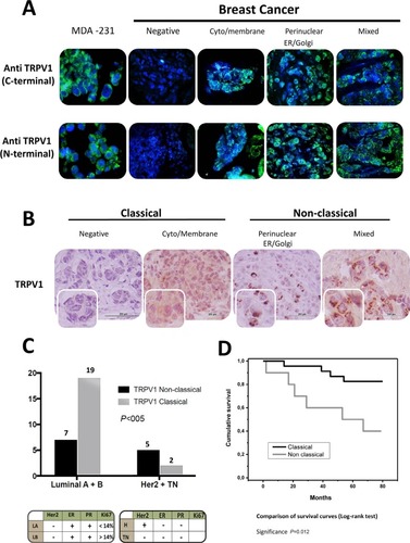 Figure 2 Nonclassical pattern of TRPV1 identifies higher malignancy breast carcinomas.