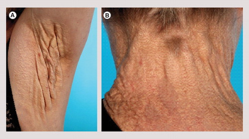 Figure 1. Changes in the skin are the common visible symptoms of the systemic/metabolic disease pseudoxanthoma elasticum.(A) Axillary plaque with severe loss of elasticity in a 56-year-old woman. (B) Late skin symptoms showing coalesced yellow papules forming a plaque surrounding the neck in a 56-year-old woman.