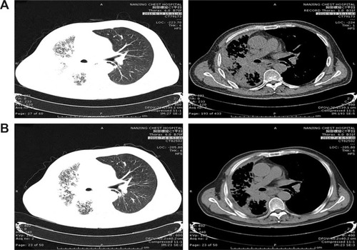 Figure 3 Patient III: Computed tomography shows the mass in the right lung (A) before apatinib treatment and (B) after apatinib treatment was given for 3 weeks.