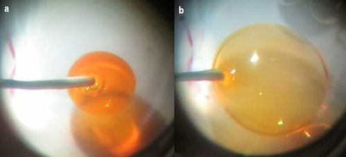Figure 3 Moving the chili oil layer after the PFCL injection. (a) PFCL injection into the chili oil layer. PFCL bubbles sank through the chili oil layer. (b) The enlarged immiscible droplet then caused the chili oil layer to move from the posterior retina.