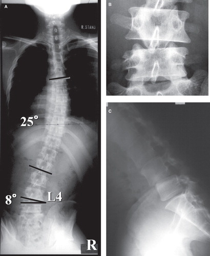 Figure 2. Preoperative plain X-rays. A: Posteroanterior view of the full spine in upright position revealed wedging of the L4/5 disc and the compensatory scoliosis in the cephalad portion of the spine. B: Posteroanterior view of the lumbar spine revealed bilateral spondylolysis of the inferior articular processes of the fourth lumbar vertebra. C: A lateral view of the spine revealed anterolisthesis of the L4 vertebra and a significant pathological opening of the posterior disc space at L4/5 in flexion position.