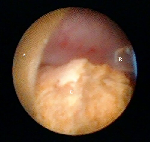 Figure 2. Holmium laser lithotripsy during microperc: (A) puncture needle sheath; (B) Holmium laser fiber; (C) kidney stones.