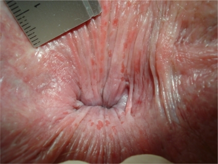 Figure 3b But if the anal skin was everted by use of the finger tips of both hands, numerous red superficial round and longitudinal gaps within the squamous epithelium proximal the dentate line are found (pruritus ani/anitis/perianal dermatitis).