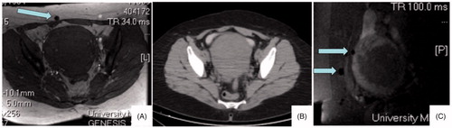 Figure 5. Axial T1 SPGR image (A) shows mild artifact (arrow) along abdominal wall with no metal on axial CT slice (B). Sagittal post contrast post MRgFUS treatment image from the same patient (C) shows artifacts along beam path (arrows).