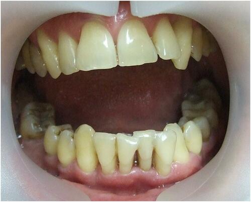 Figure 5 Intraoral view 6 months after SRP.