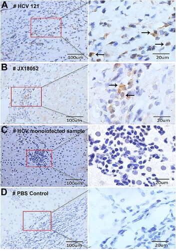 Figure 4. Detection of HPgV-2 antigen in liver tissues. Immunohistochemical (IHC) staining of liver biopsies was performed for HCV/HPgV-2 co-infected patients HCV121 (A) and JX18052 (B), using anti-HPgV-2 NS5A antibody as the primary antibody; HPgV-2 antigens were specifically stained brown in the infiltrative lymphocytes, but not in the hepatocytes. No specific signals were observed in the HCV positive, HPgV-2 negative patient (C). The negative control was stained using PBS to replace the primary antibody, anti-HPgV-2 (D).