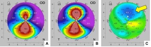 Figure 5 Pentacam scans (front or sagittal curvature) of early regression of conductive keratoplasty (CK) effect over ~26 hours. (A) The map shows a case ~26 hrs after CK treatment compared to (B), a scan taken immediately after CK treatment, but before any crosslinking treatment. (C) Demonstrates the difference between A and B (digital subtraction map) showing ~6 diopters of early regression since the CK treatment (yellow arrow).