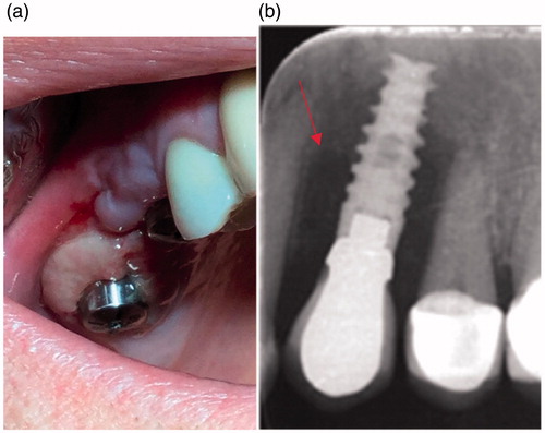 Figure 3. Clinical symptoms of chronic infection around implant healing abutments with fibrotic, inflammatory overgrowth of the gingiva (a) and radiological findings around dental implant bone resorption (red arrow) (b).