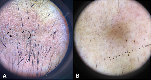 Figure 2 (A) dermoscopic picture showing white gelatinous filaments protruding through follicular openings “demodex tails” (arrows), and reticular perifollicular pigmented network (circle). (B) dermoscopic picture showing improvement after 3 months of treatment with ivermectin 1% cream.