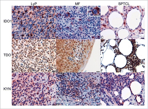 Figure 3. Expression of IDO1, TDO, and KYN in tissue specimens of CTCL as determined by immunohistochemistry. (A) Expression of IDO1 in LyP. (B) Expression of IDO1 in TME of MF specimen and in macrophages surrounding the malignant cells (enlarged insert, upper right corner). (C) IDO-positive cells surrounding the adipocytes in SPTCL, (D) Expression of TDO in LyP. (E) Expression of TDO in MF. (F) Expression of TDO in SPTCL (G) Expression of KYN in LyP. (H) Expression of KYN in MF. (I) Expression of KYN in SPTCL. (Scale bar 20 µm and 40x magnification).