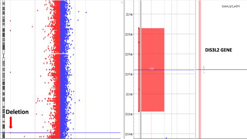 Figure 3 Array comparative genomic hybridization analysis revealed two-copy loss of the long arm of chromosome 2 within the cytogenetic band 2q37. The deletion was ~204 kilobases (kb) in size and caused intragenic deletion in the DIS3L2 gene.