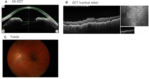 Figure 3 Patient 2’s AS-OCT, OCT, and Fundus results at 41 days after microhook surgery. (A) As shown by AS-OCT, ciliary detachment was present on both the nasal and temporal sides. The nasal ciliary detachment was larger. (B) OCT sliced vertically on the macular area. Radial folds around the fovea as hypotonic maculopathy were observed. (C) Fundus results: chorioretinal folds characteristic of hypotonic maculopathy were observed.