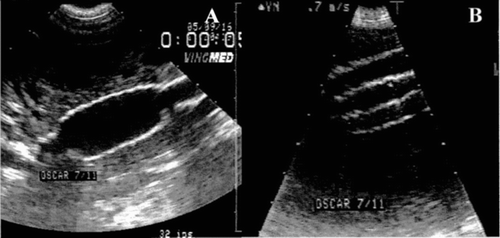 Figure 10 Echodoppler illustrations of observations carried out before (A) and immediately after the deployment of the stent-graft (B) in a dog 113 days after the creation of the aneurysm.