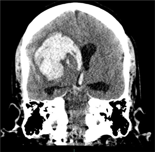 Figure 3 CT of head: Coronal reformat showing large right intra-cerebral hemorrhage extending in to right lateral and third ventricles; mass effect with effacement of sulci and midline shift to the left.