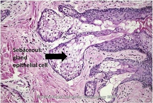 Figure 1 Sebaceous gland of normal skin.Source: Graham Library of Digital Images, Wake Forest University Department of Dermatology. © 2009 Wake Forest University Dermatology.