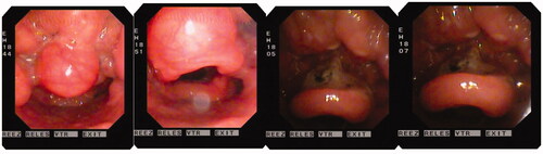 Figure 1. Results of laryngoscopy and intraoperative images.