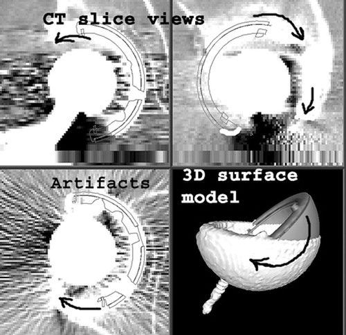 Figure 2. Computer screen view of pelvic CT slices and cup surface model. A CAD (computer-aided design) graphic model of the cup was superimposed on the segmented surface model and its orientation was continuously modified (see arrows) until the best possible match was found between the two models. This final orientation was recorded in terms of cup abduction and version with respect to the previously defined anatomic reference system.