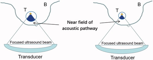 Figure 7. Schematic diagram of fibroadenoma with different sizes in the near field of acoustic pathway.