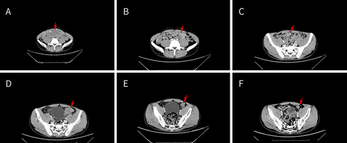 Figure 3 (A) Before chemotherapy, CT scan reveals abdominal masses (red arrow), (B,C) after 2 cycles of chemotherapy, abdominal masses was shrinking (red arrow), (D) after 5 cycles of chemotherapy, enlarged lesions next to the left iliac vessels (red arrow), (E) 1 month after radiotherapy, the lesions decreased (red arrow), (F) 3 months after radiotherapy, the lesions decreased further (red arrow).