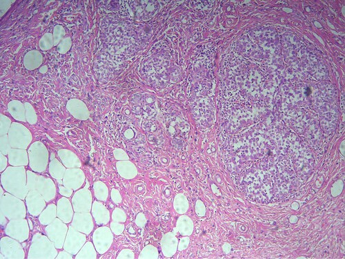 Figure 1. Breast ductal carcinoma (demonstrated by Hematoxylin and Eosin staining (X 100).