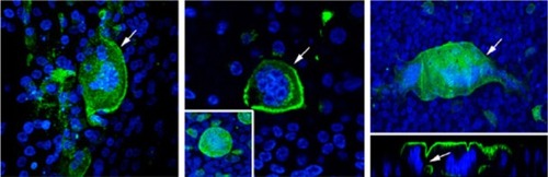 Figure 1 RSV causing syncytia formation.