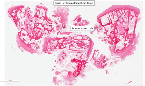 Figure 6. Regions of avascular necrosis underlying cancellous bone of right scaphoid. Reference of 5 mm.
