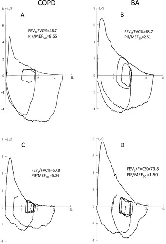 Figure 1. (A) and (B) Typical flow-volume tracings in COPD and BA patients who had FEV1 values close to average of each group. Although peak expiratory flow and maximal expiratory flow 50% FVC (MEF50) was significantly reduced in COPD, peak inspiratory flow (PIF) was well preserved resulting in PIF/MEF50 being significantly higher in COPD than BA. (C) and (D) Flow volume tracings of COPD and BA patients who could performed forced inspiration from FRC to TLC but failed to achieve an adequate forced-inspiration from RV to TLC. PIF/MEF50 was larger in COPD than BA.