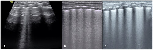 Figure 9. The identification of GOS and B-lines. It can be seen that the echogenicity of B-line (A) and confluent B-line (B) in far-field of the lung did not decrease significantly, while the echogenicity of GOS (C) significantly fading in the in far-field.