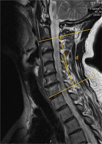 Figure 1 The sagittal alignment of the cervical spine was defined as the angle by the caudal endplates of C2 and C7 in magnetic resonance imaging (d).