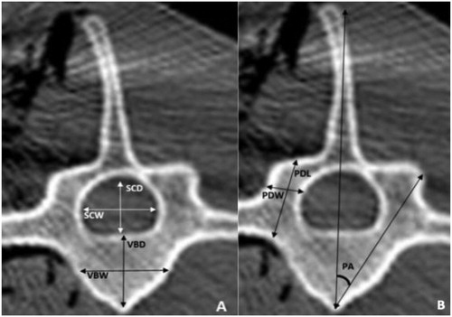 Figure 2. Parameters measured on each vertebrae on the transverse CT image. Measured verterbral body parameters (A) were: vertebral body width (VBW), vertebral body depth (VBD), Spinal canal width (SCW) spinal canal depth (SCD). Measured pedicle parameters (B) were: Pedicle length (PDL), pedicle width (PDW) and pedicle axis angle.