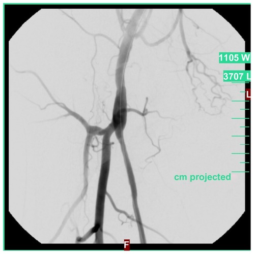 Figure 4 Reperfusion after two rotation thrombectomy passes.