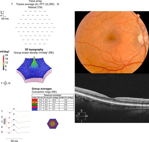 Figure 2 Color fundus photography, multifocal electroretinography (mfERG), and spectral domain optical coherence tomography (SD-OCT).