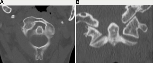 Figure 3 (A) Computed tomography scan of the upper cervical spine showing an axial cut which demonstrates a type II atlanto-axial rotatory subluxation which is consistent with the patientߣs neck position (rotation to the contralateral side). (B) Coronal cut showing gapping on the left C1ߝC2 articulation and compression on the right side, which is consistent with the patientߣs neck position (ipsilateral head tilt).